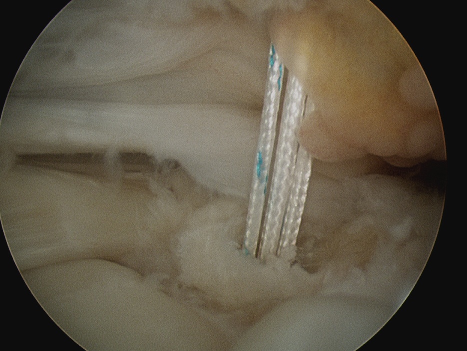 RCR Arthroscopic Anchor 2